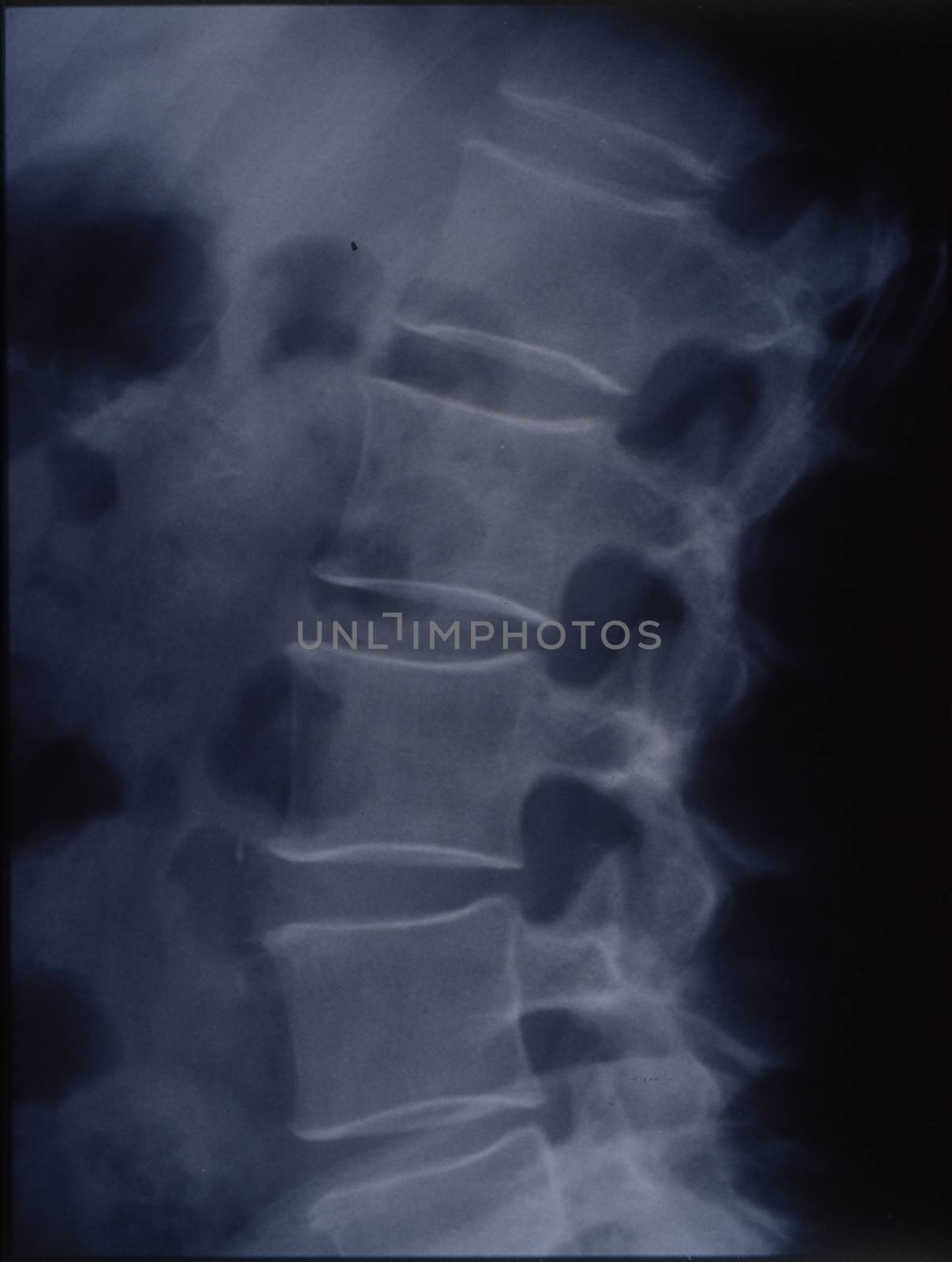 X-ray image of the spine for medical diagnosis