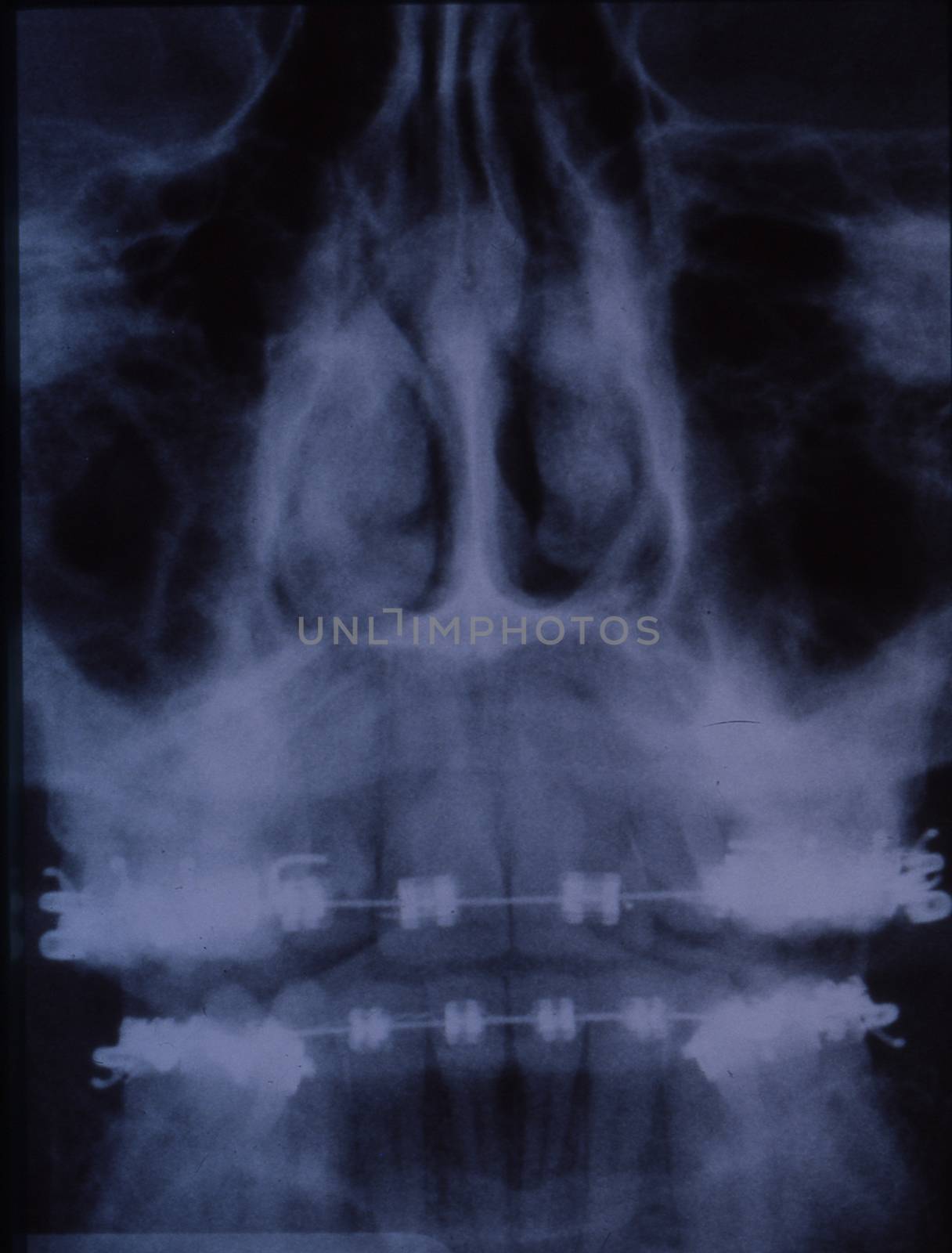 X-ray image of the dentition with braces and teeth by Dr-Lange