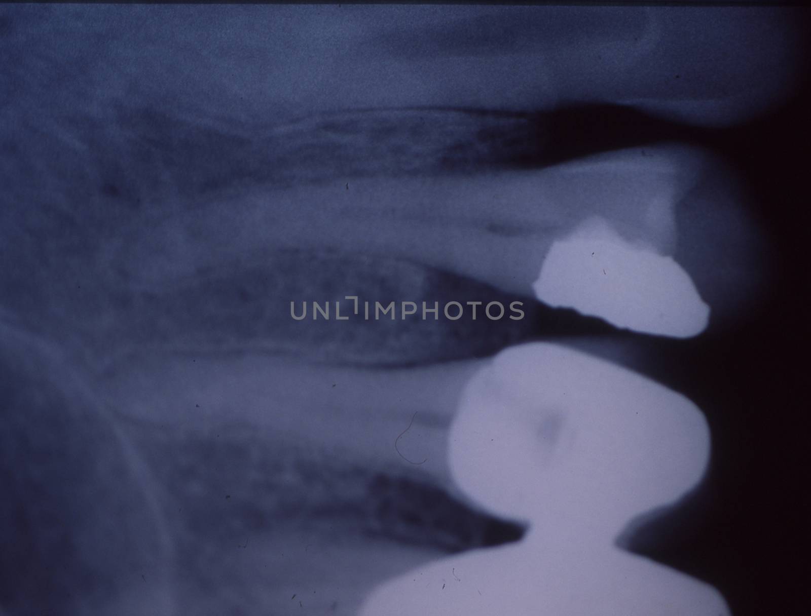 X-ray image of teeth with fillings and bridges by Dr-Lange