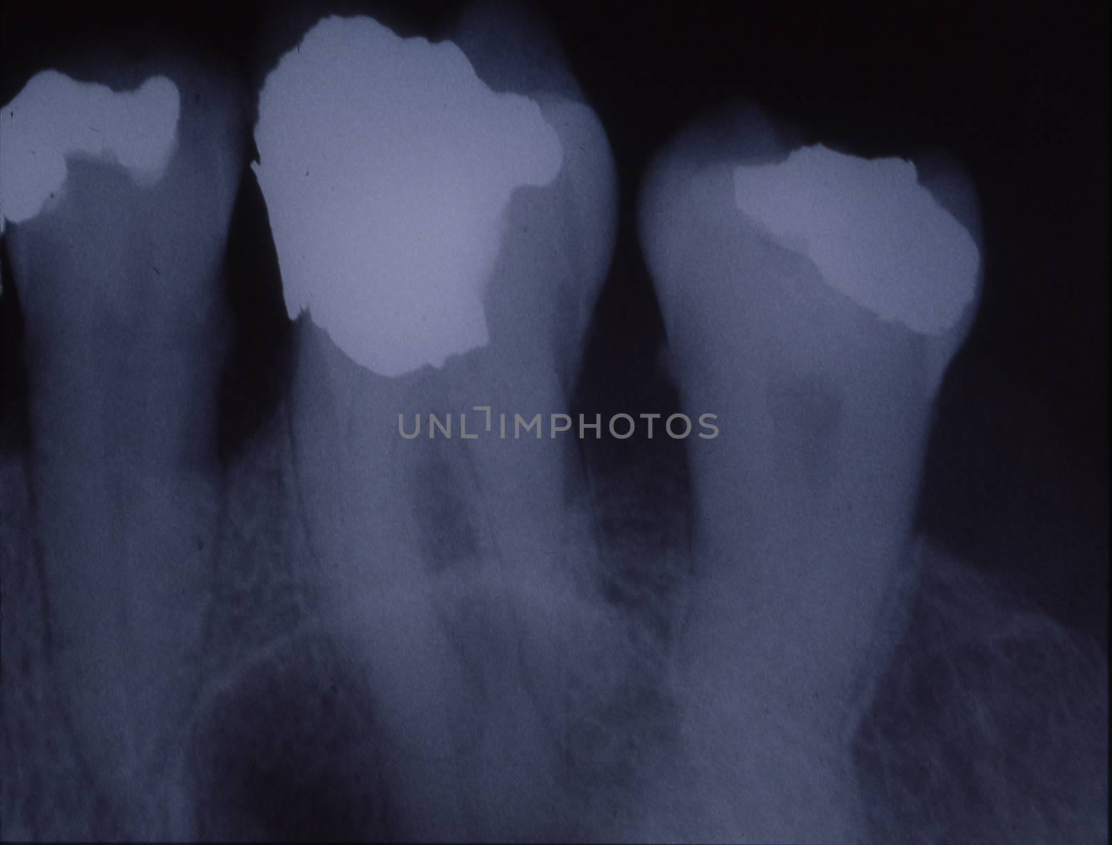 X-ray image of teeth with fillings and bridges by Dr-Lange