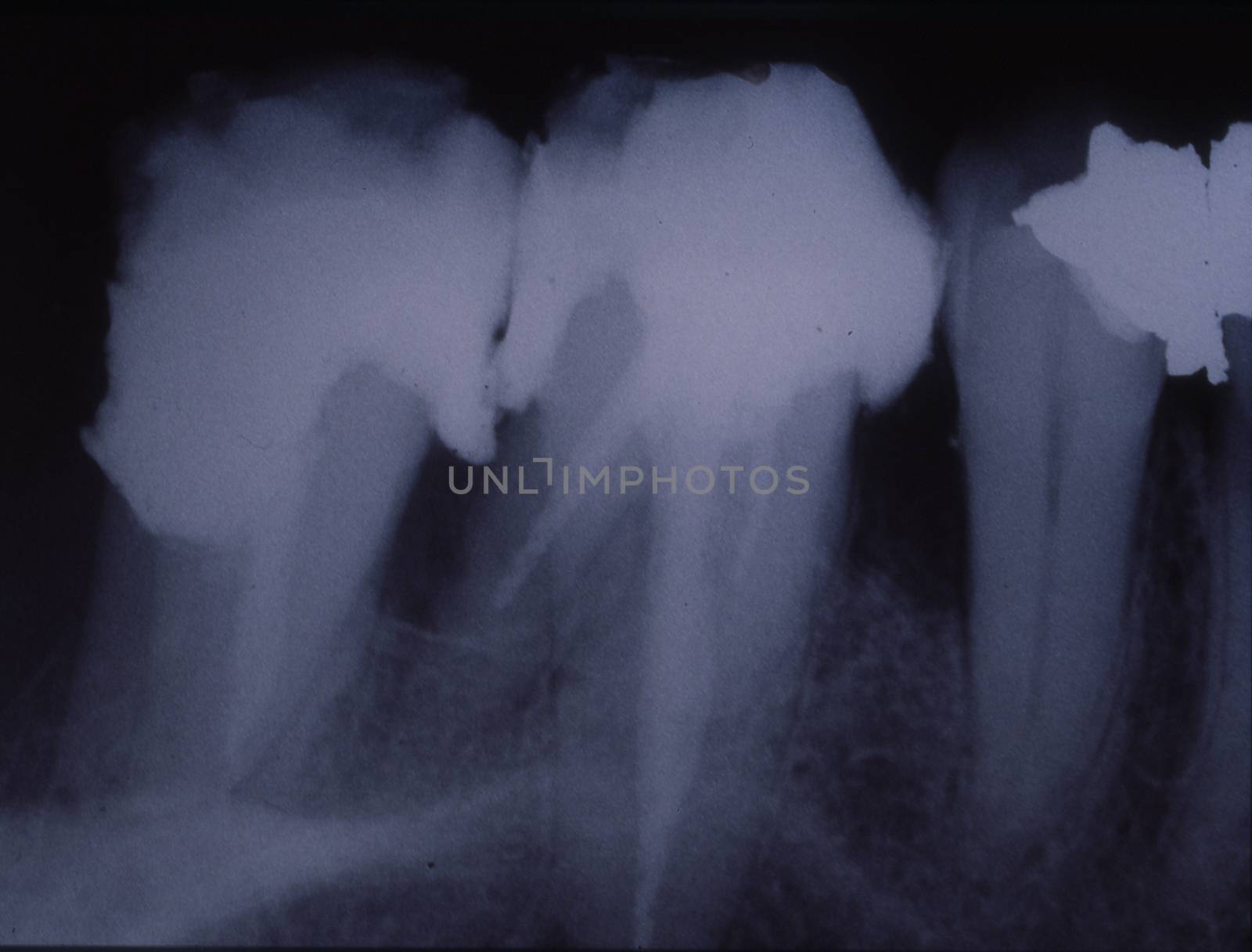 X-ray image of teeth with fillings and bridges by Dr-Lange