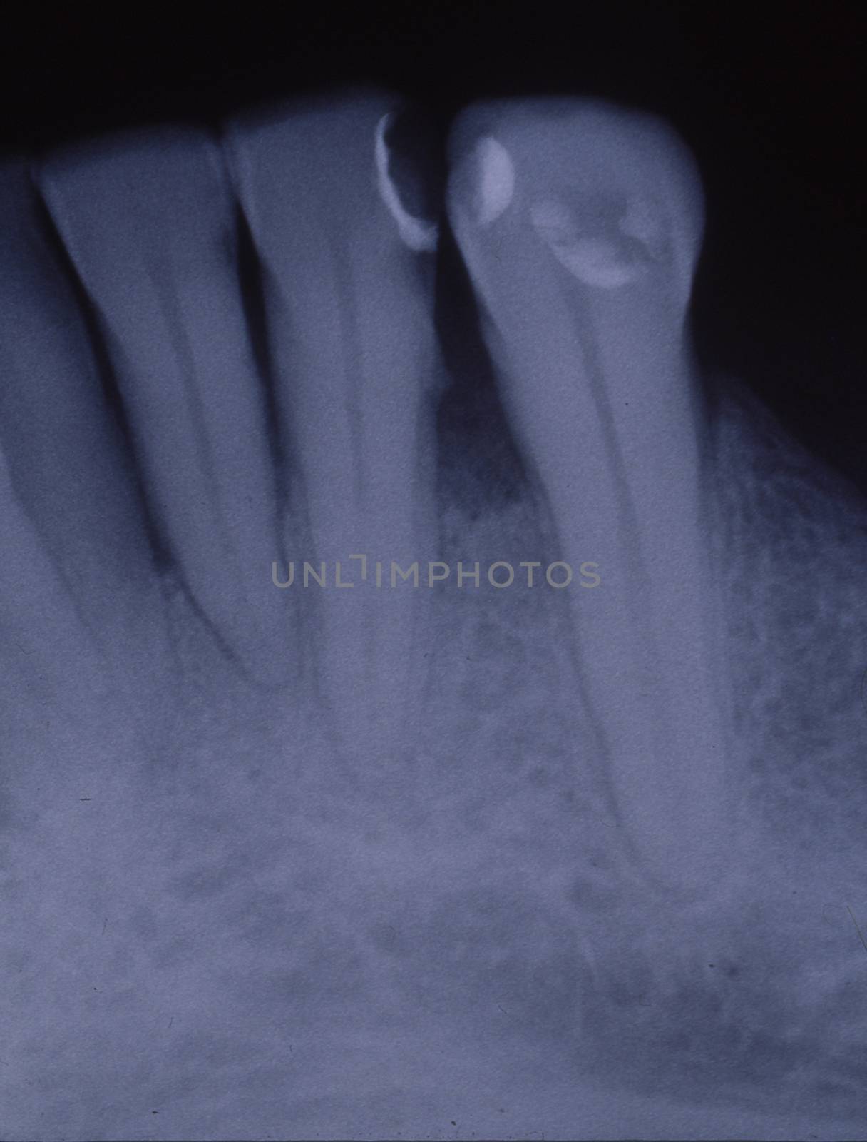 X-ray image of teeth with fillings and bridges by Dr-Lange
