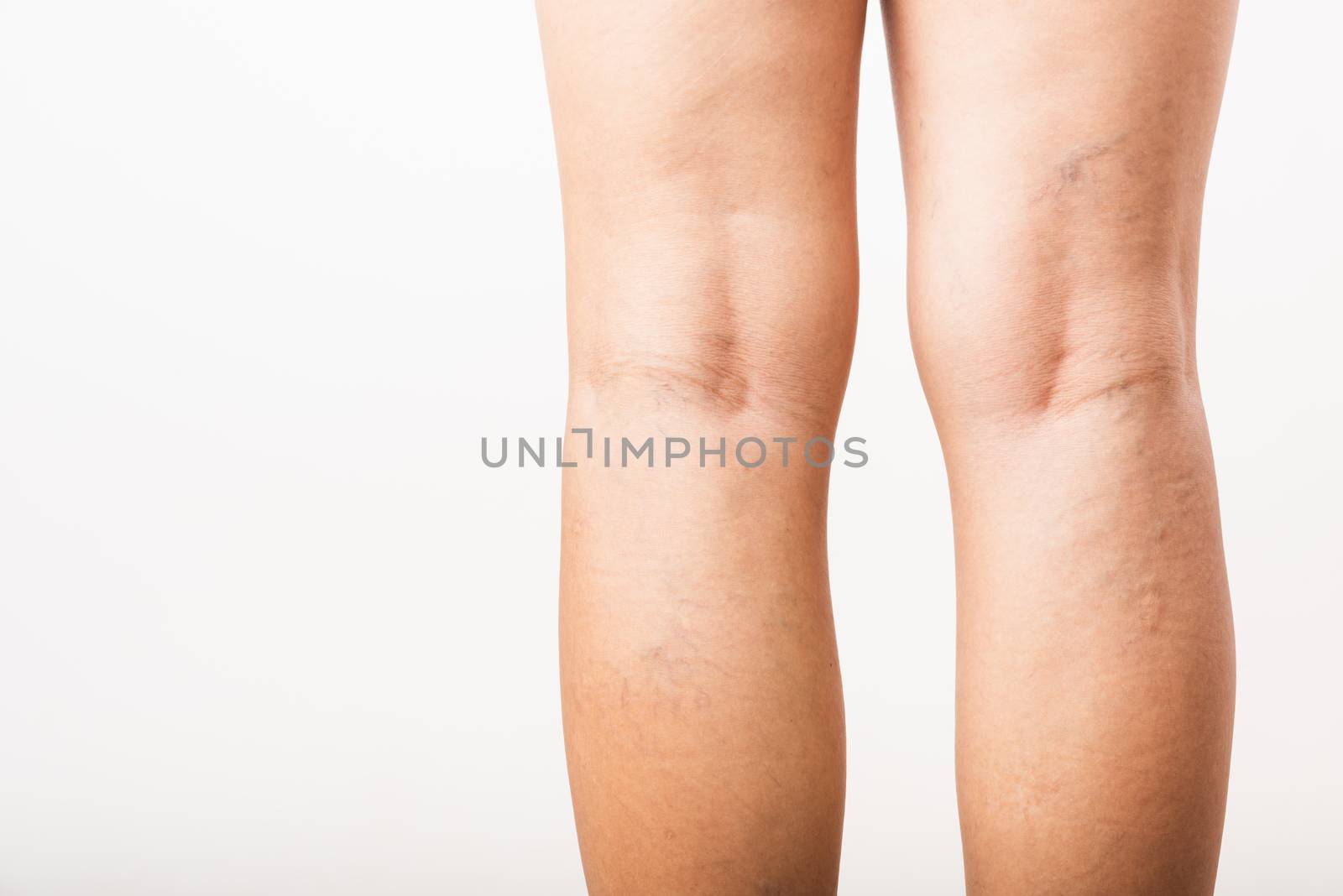 Closeup young Asian woman painful varicose and spider veins on leg, studio shot isolated on white background, Healthcare medical and hygiene skin body varicose veins problems care concept