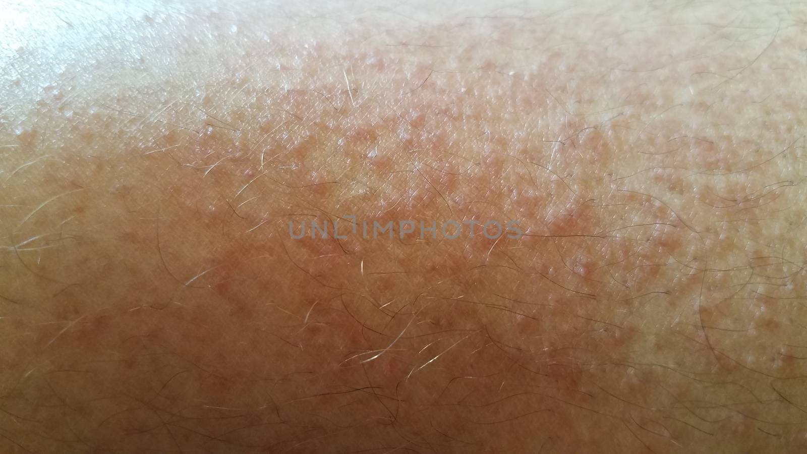 red rash or inflammation on male leg by stockphotofan1