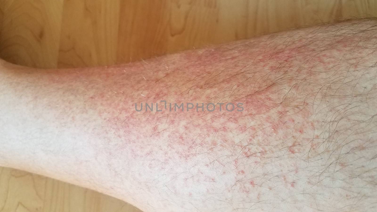 red rash or inflammation on male leg by stockphotofan1