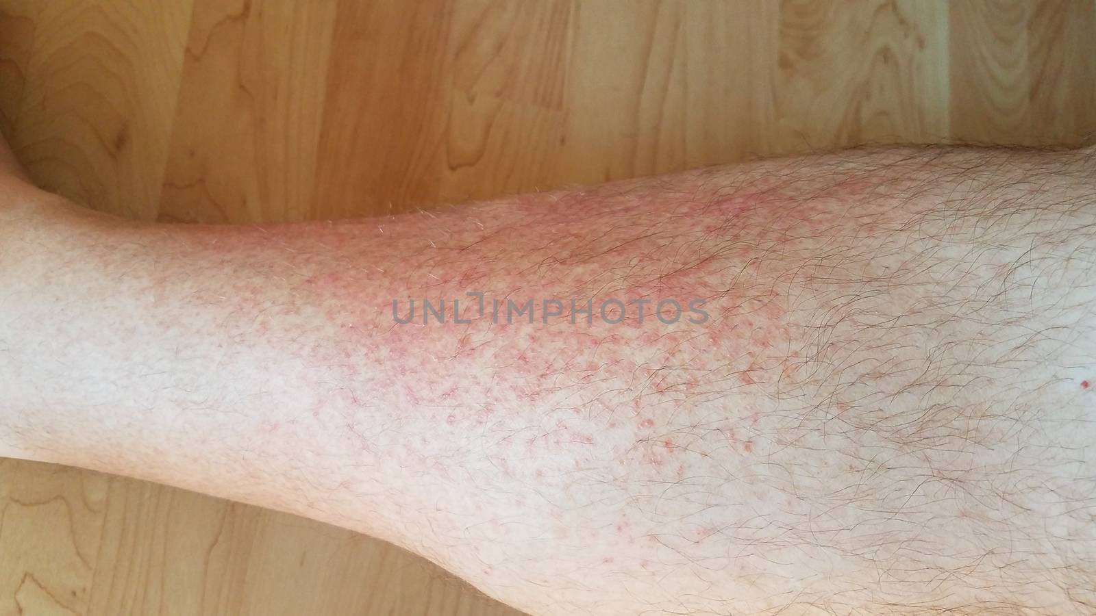 red inflammation dots on man's leg with hair by stockphotofan1