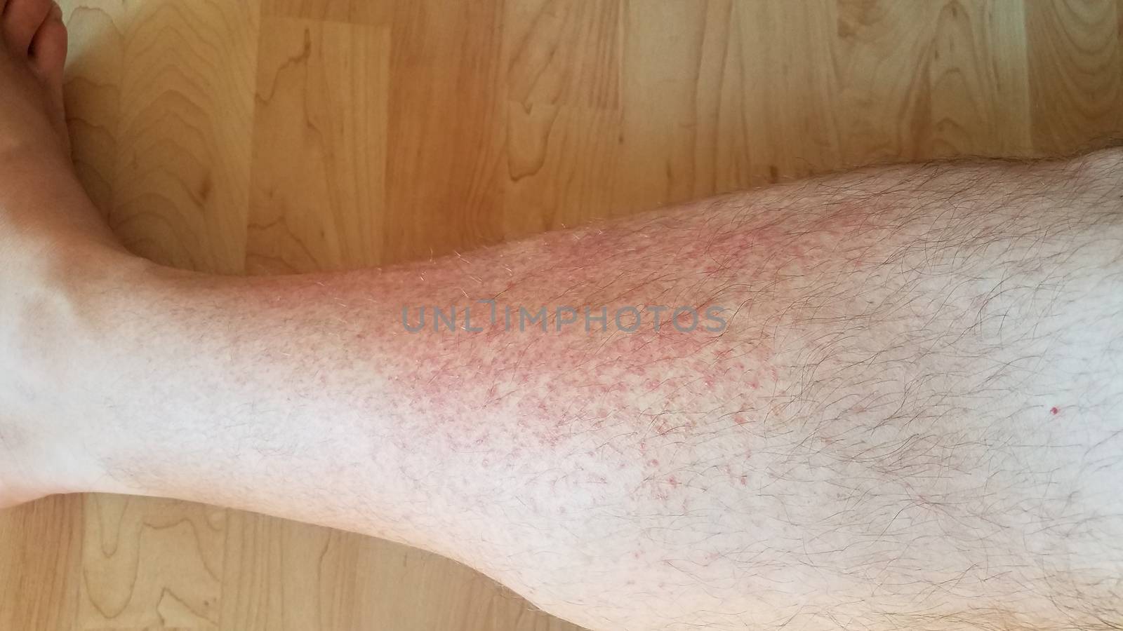 red inflammation dots or spots on man's leg with hair