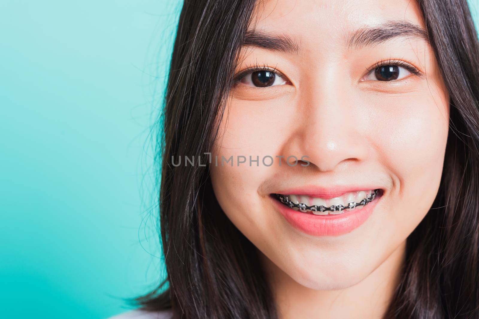 Closeup teen Asian beautiful young woman smile have dental braces on teeth laughing, studio shot isolated on a blue background, medicine and dentistry female mouth concept