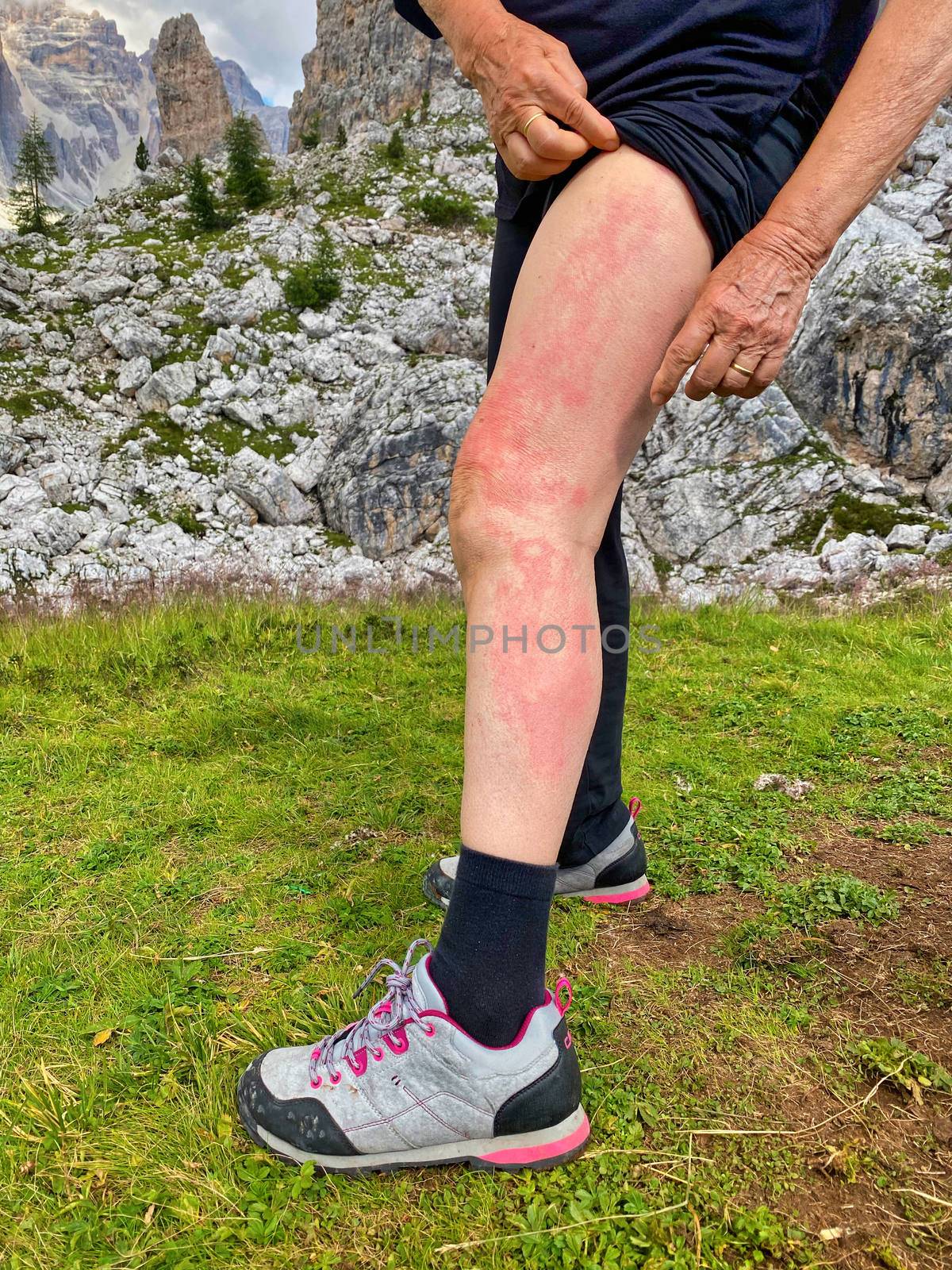 Elderly woman showing an allergy to her left leg by jovannig