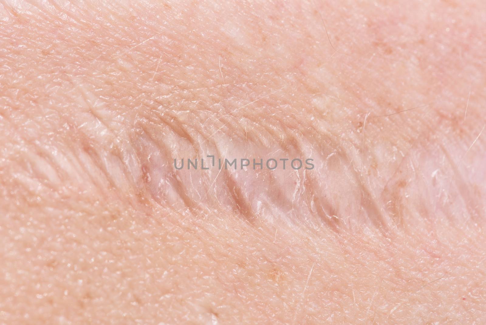 Scar on the skin. Human scar close-up