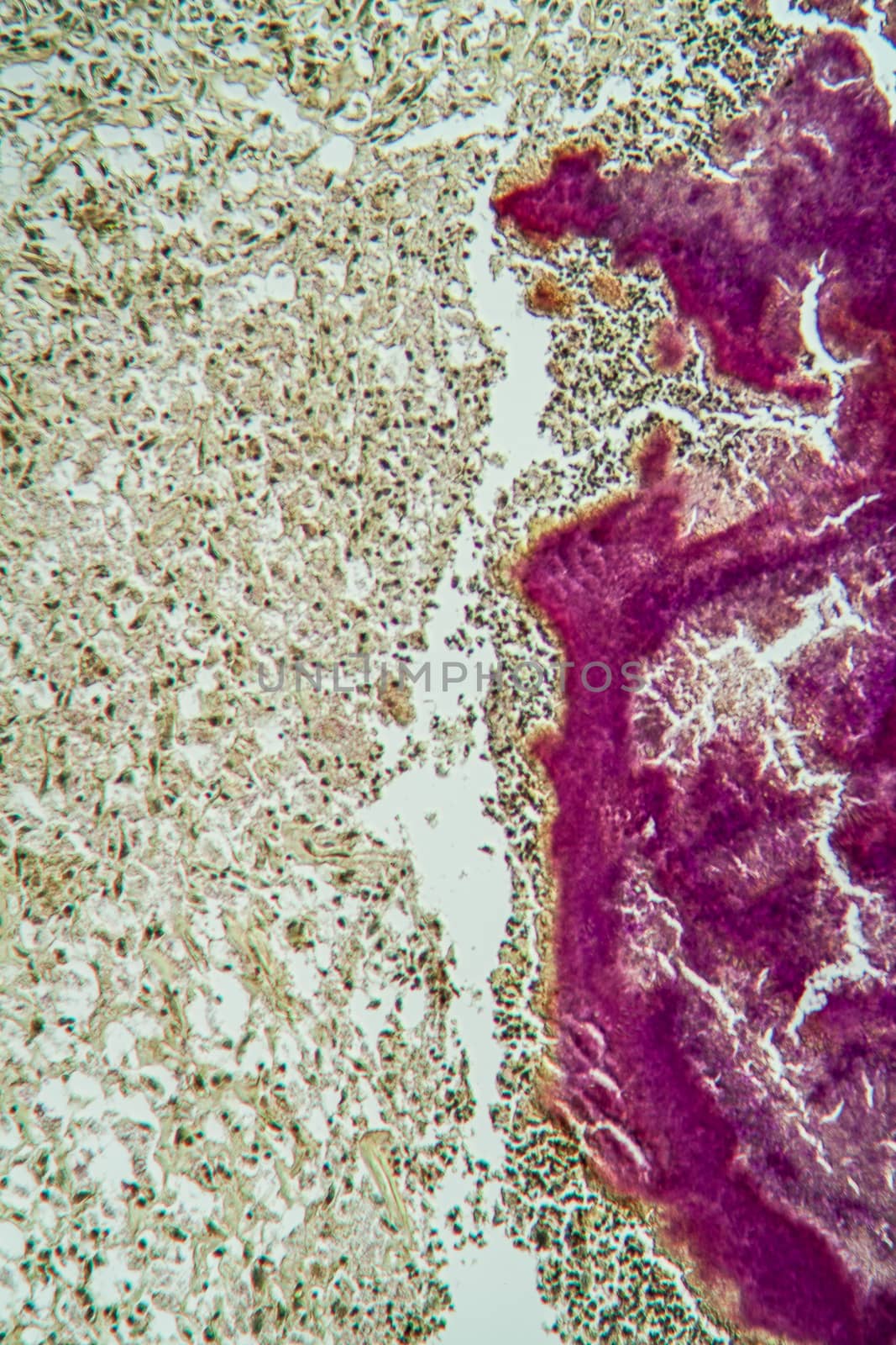 Actinomyces disease under the microscope 100x by Dr-Lange