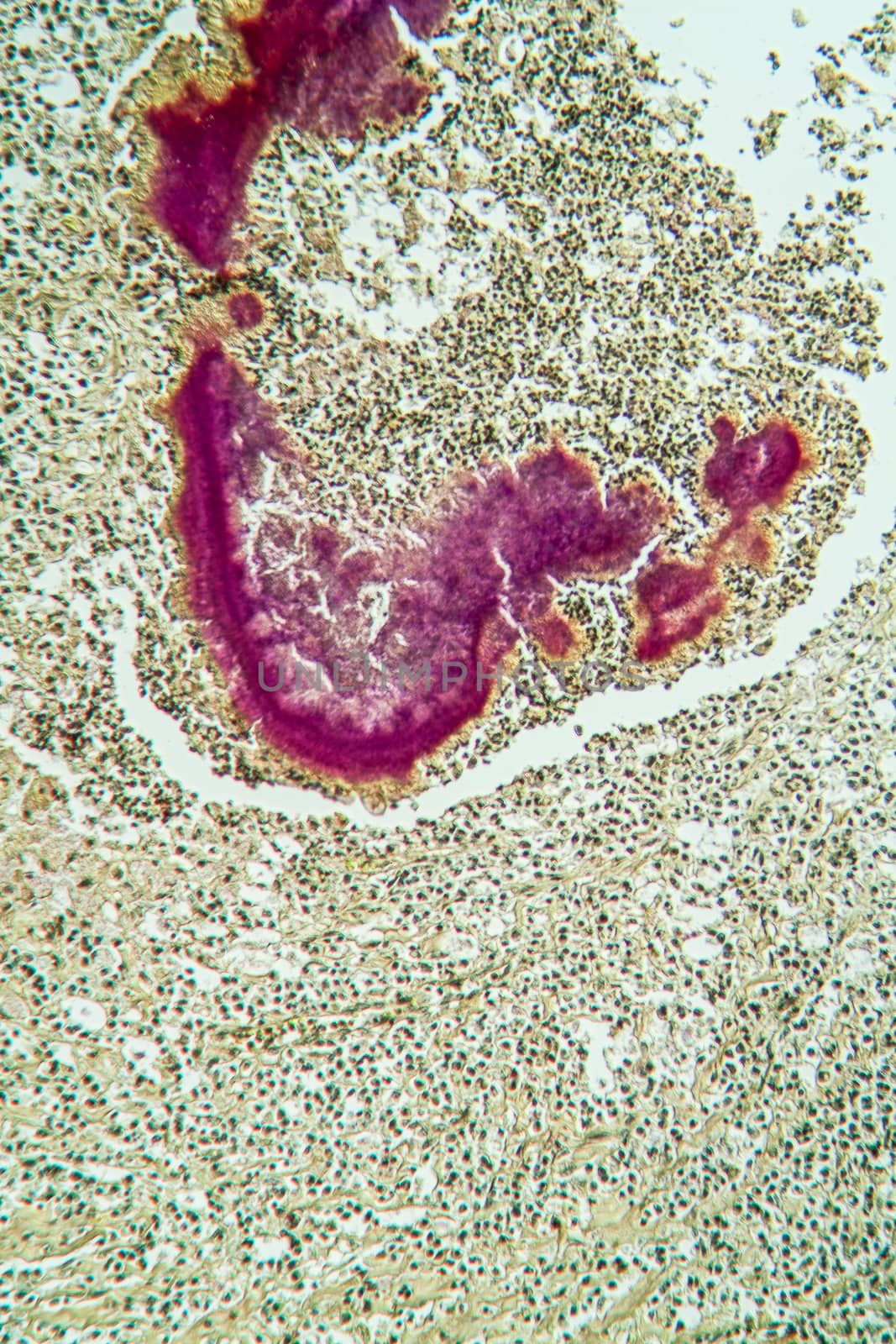Actinomyces disease under the microscope 100x