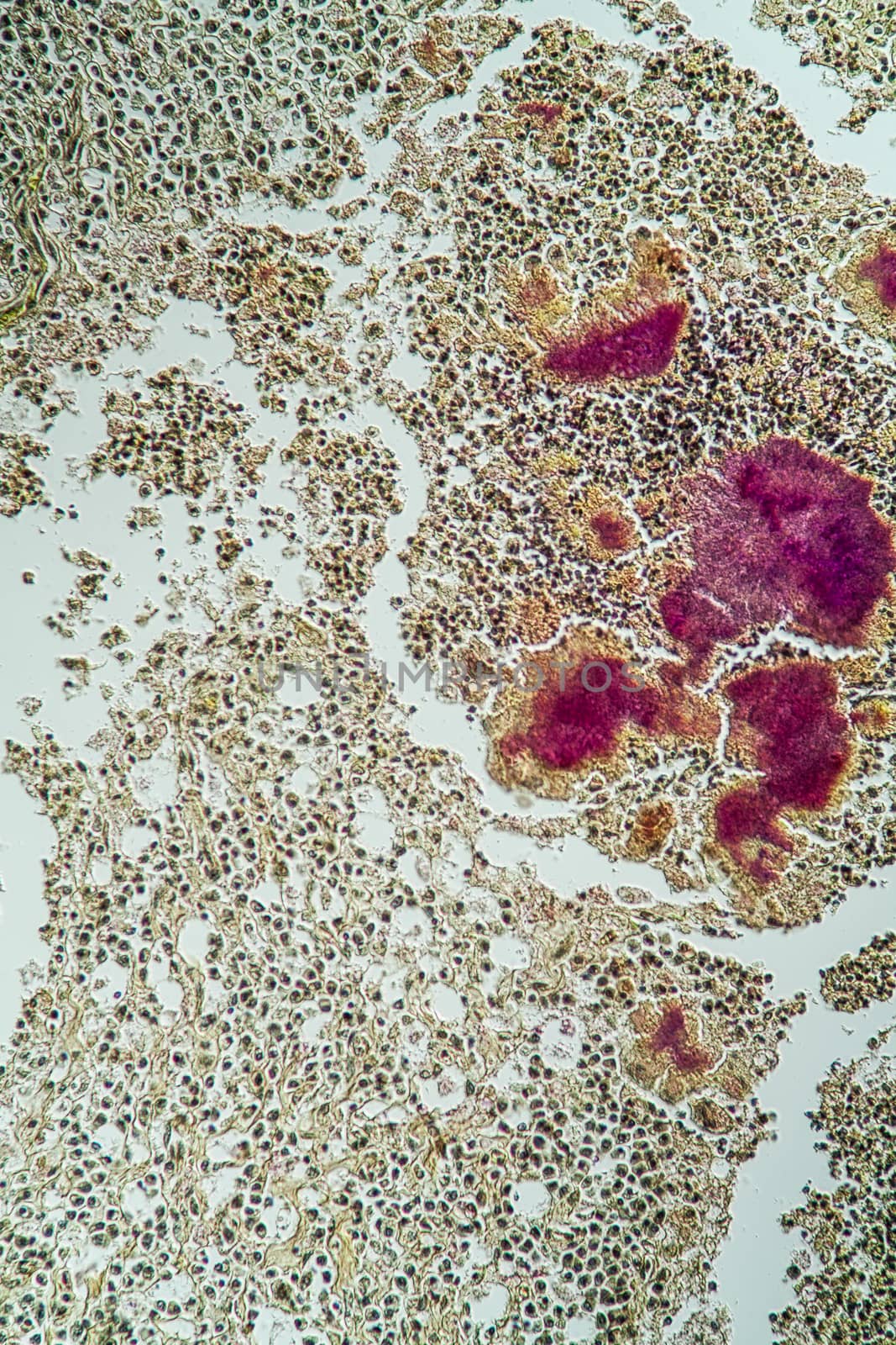 Actinomyces disease under the microscope 100x by Dr-Lange