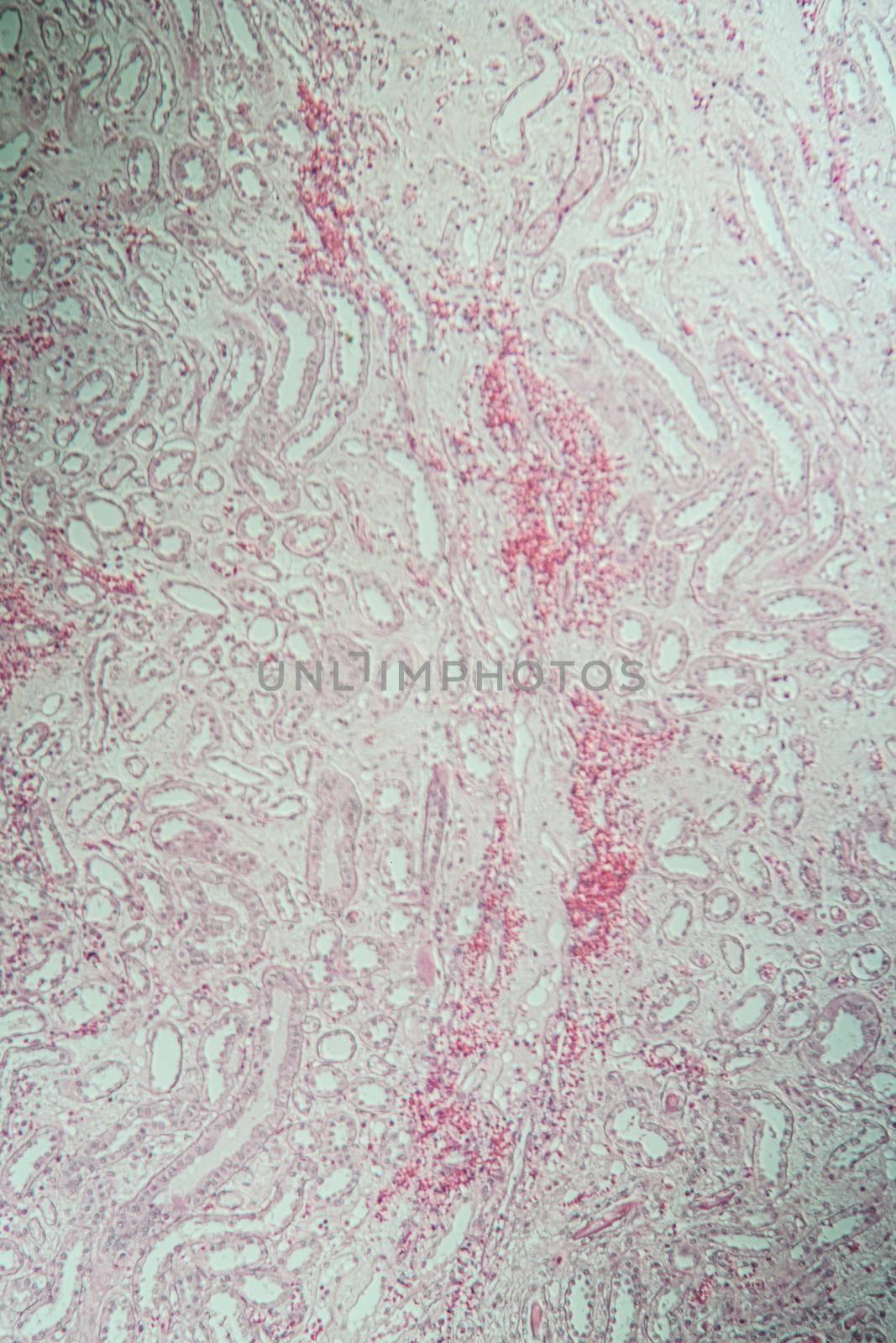 Poly nephritis, tissue under the microscope 100x by Dr-Lange