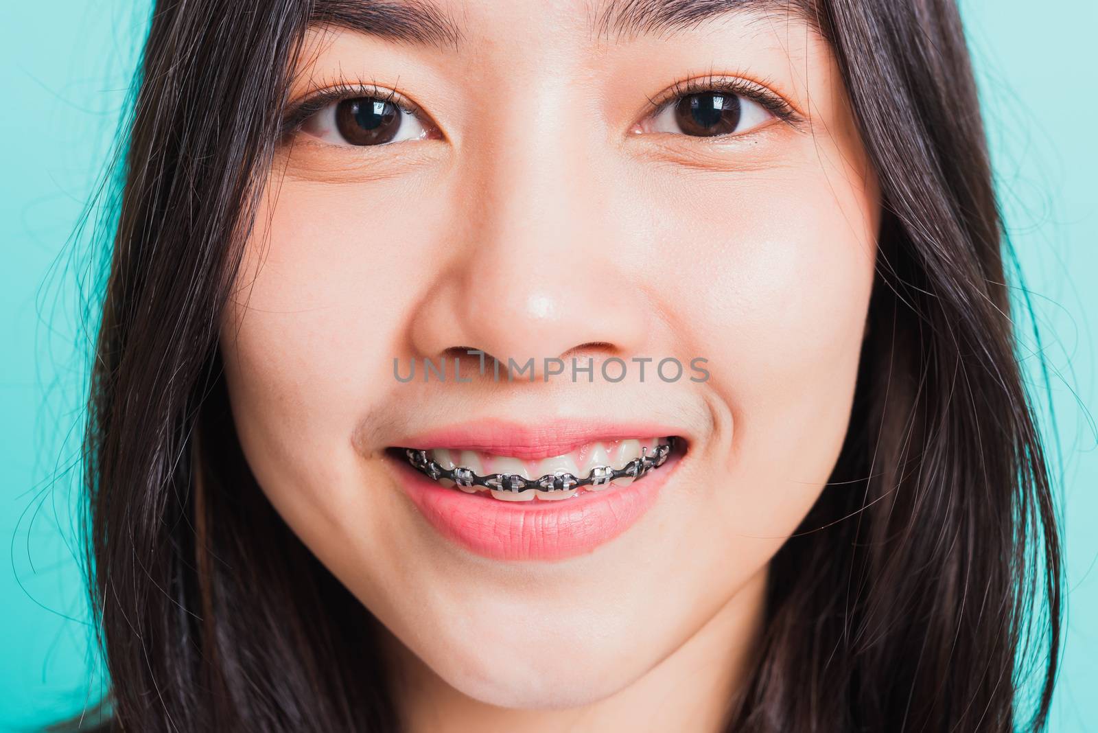 Wman smile have dental braces on teeth laughing by Sorapop