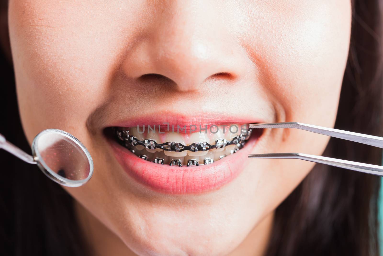 Asian teen beautiful young woman smile have dental braces on teeth laughing and have medical equipment tools for check tooth, isolated on a blue background, Medicine and dentistry concept