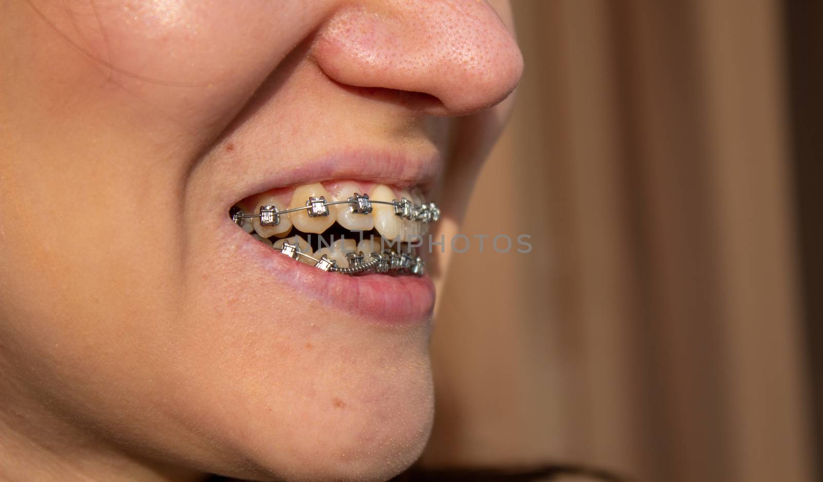 brasket system in smiling mouth, macro photo teeth, close-up lips, macro shot. by AnatoliiFoto