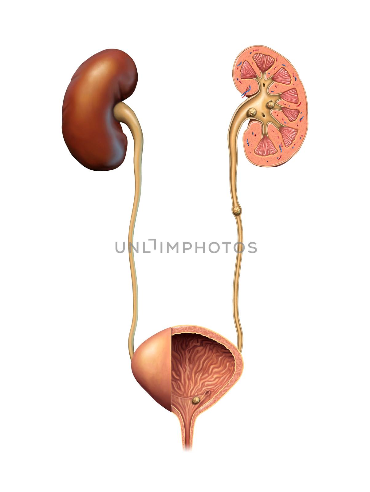 Kidney and urinary stones formation. Digital illustration.