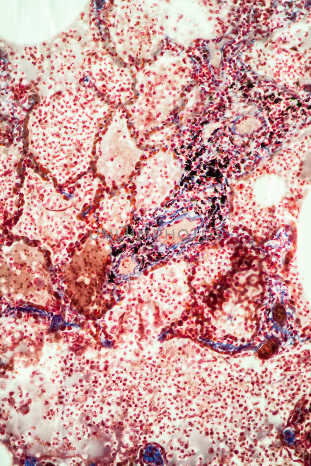 Tuberculosis tissue under the microscope 100x