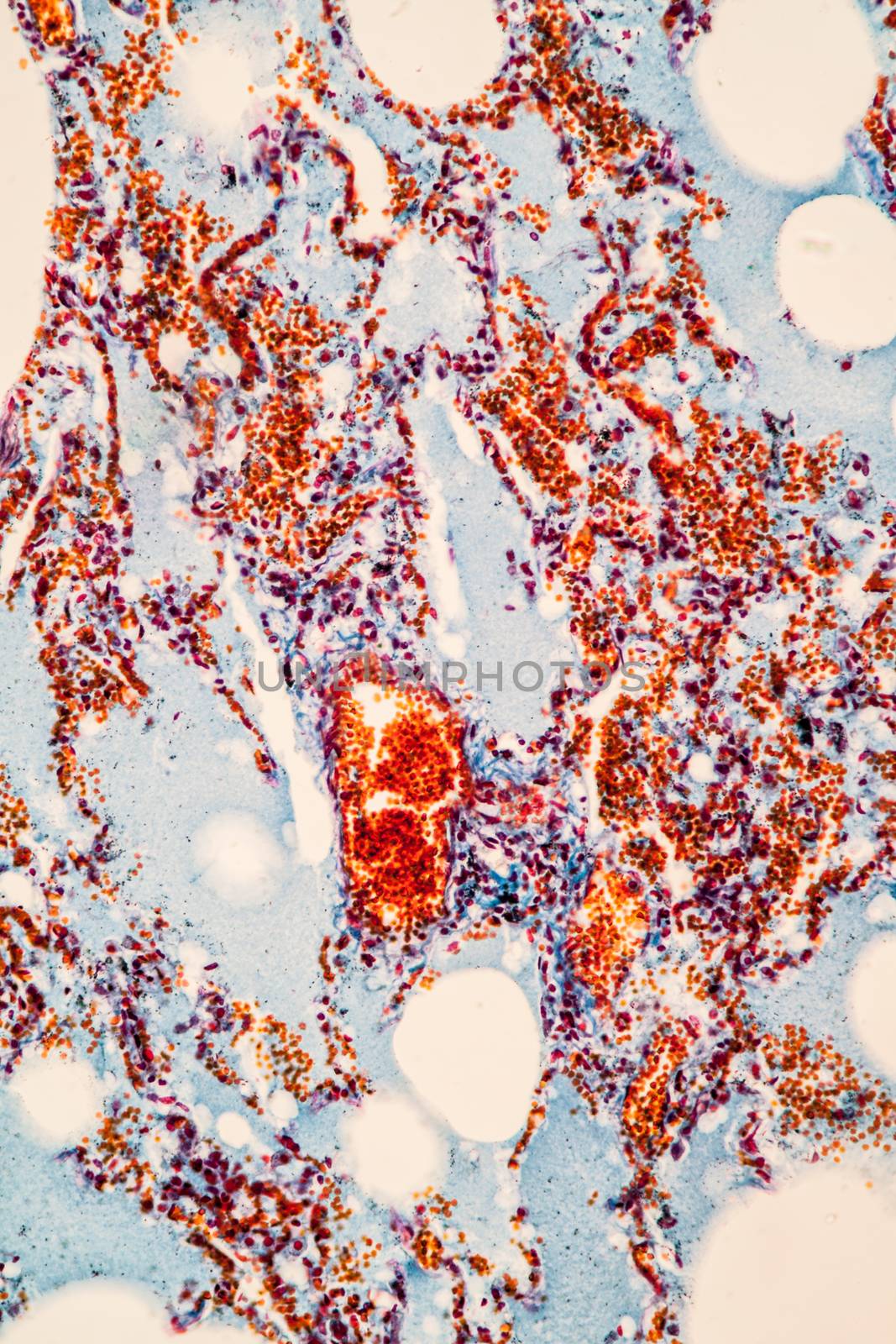 Flu of the lungs Diseased tissue 200x by Dr-Lange