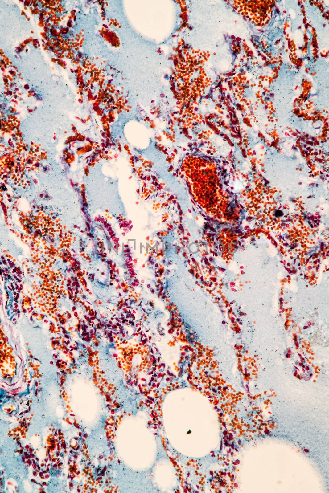 Flu of the lungs Diseased tissue 200x