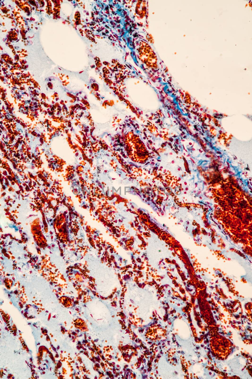 Flu of the lungs Diseased tissue 200x