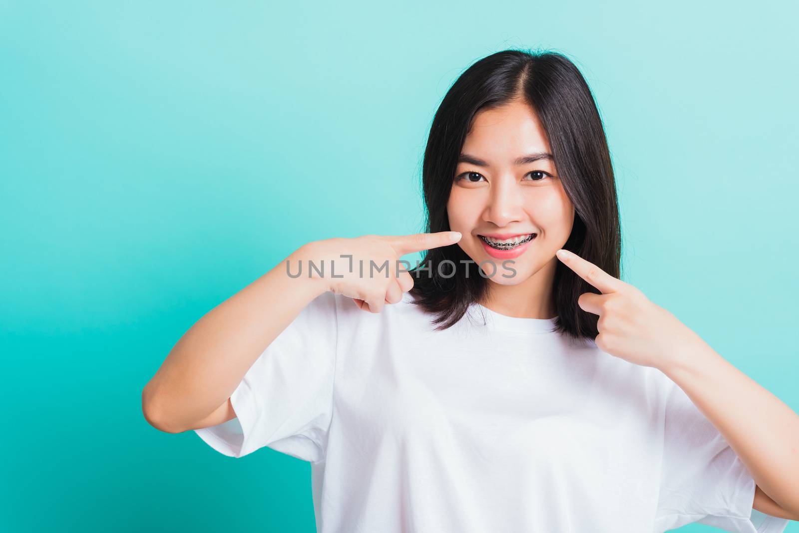 Portrait of Asian teen beautiful young woman smile have dental braces on teeth laughing point finger her mouth, studio shot isolated on a blue background, Medicine and dentistry concept