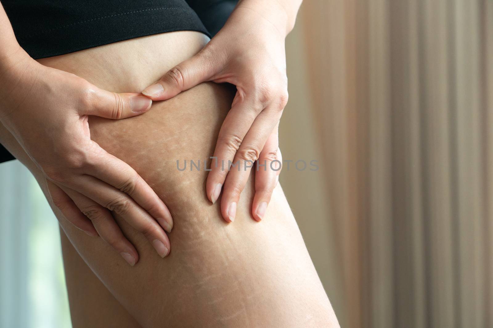 Female hand holds fat cellulite and stretch mark on leg at home, women diet style concept