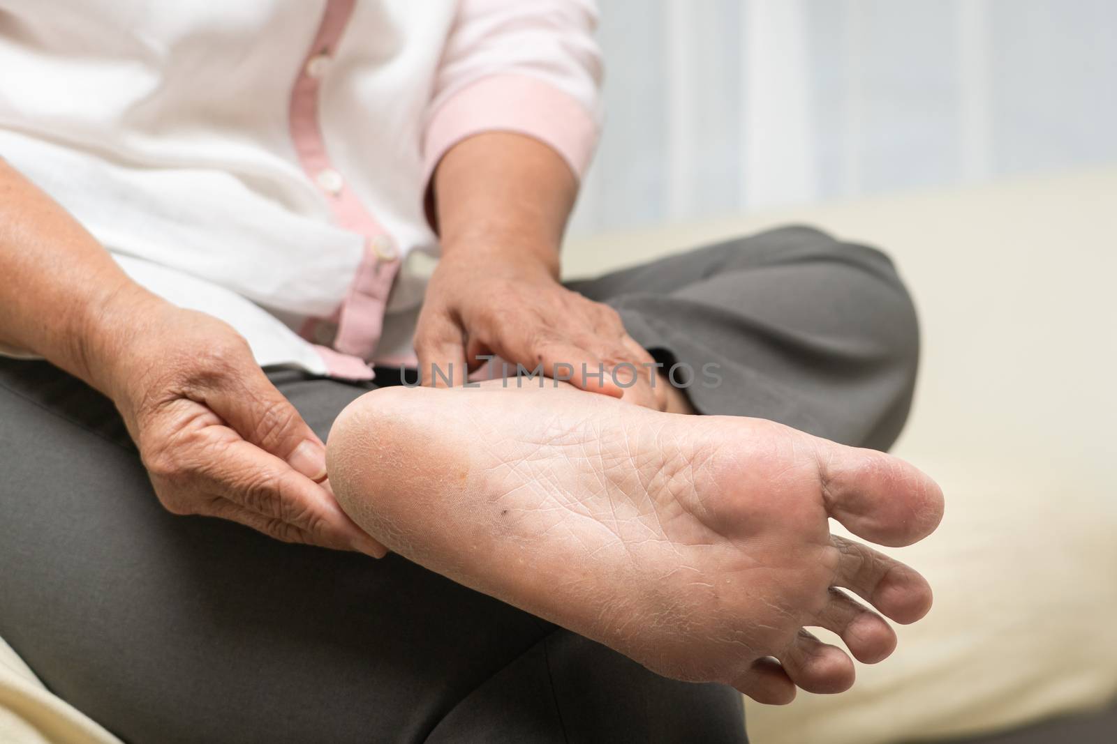 dry skin and cornea on senior woman foot by psodaz