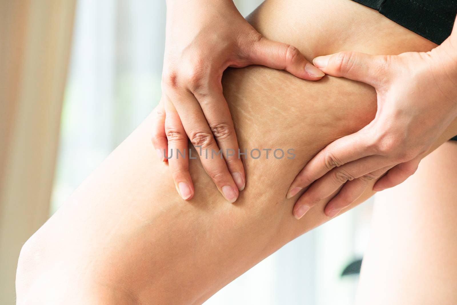 Female hand holds fat cellulite and stretch mark on leg at home, women diet style concept