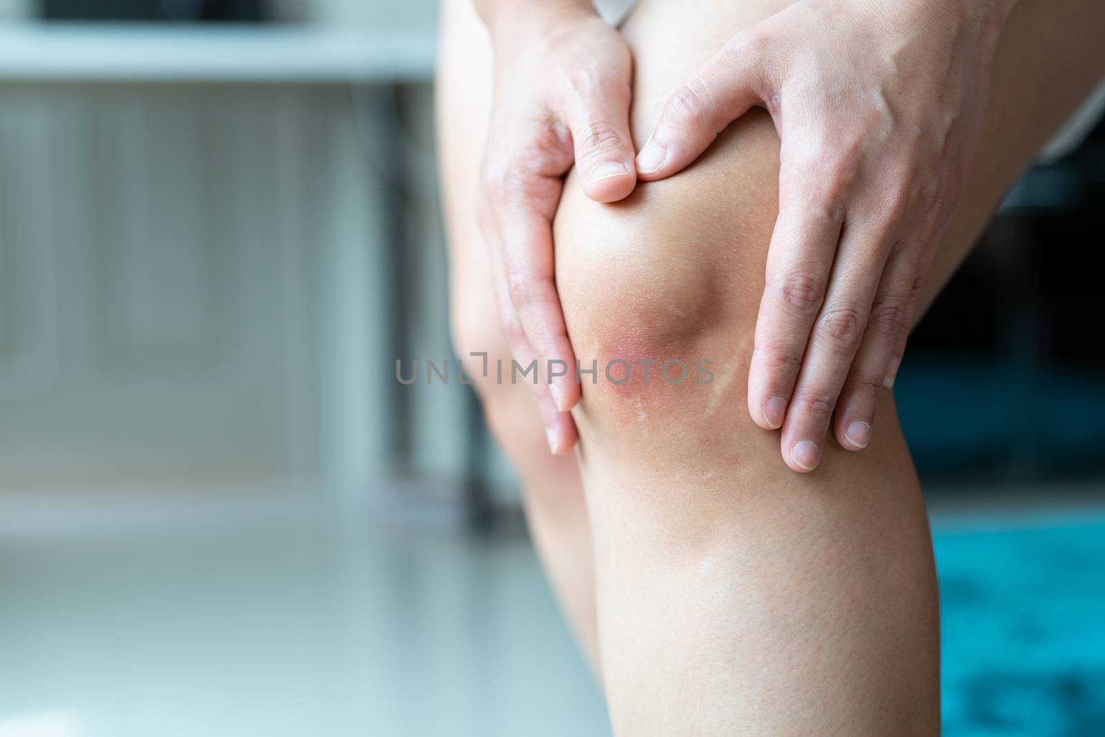 bruised knee of asia woman, selective focus by psodaz