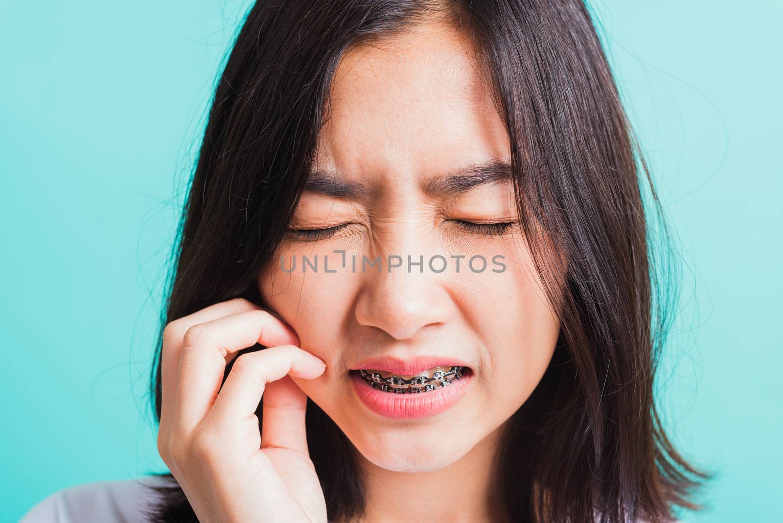 woman smile have dental braces on teeth laughing she unhappy pai by Sorapop