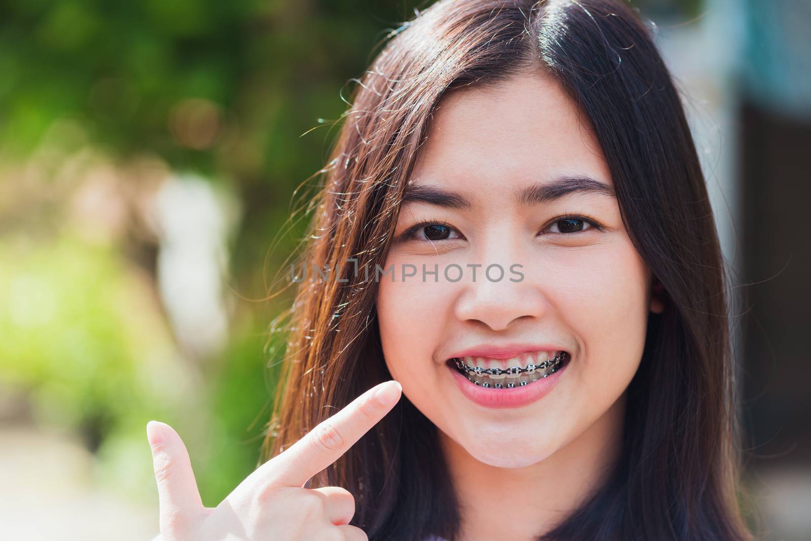 woman smile have dental braces on teeth laughing at outdoor she  by Sorapop