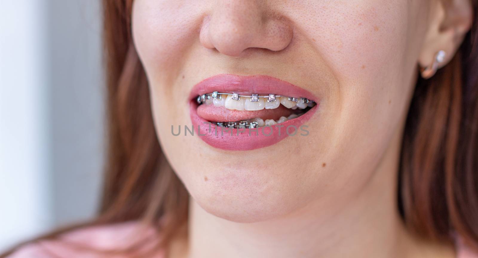 Brace system in a girl's smiling mouth, macro photography of teeth, close-up of lips. The girl stuck out her tongue