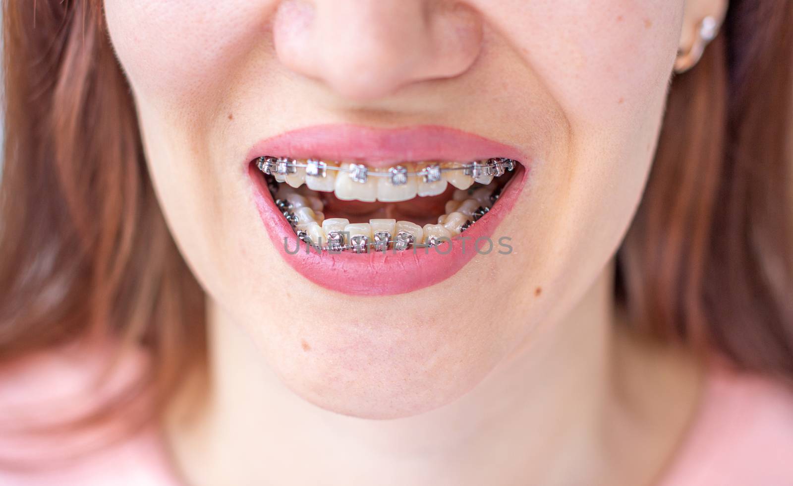 Brasket system in a girl's smiling mouth, macro photography of teeth, close-up of lips