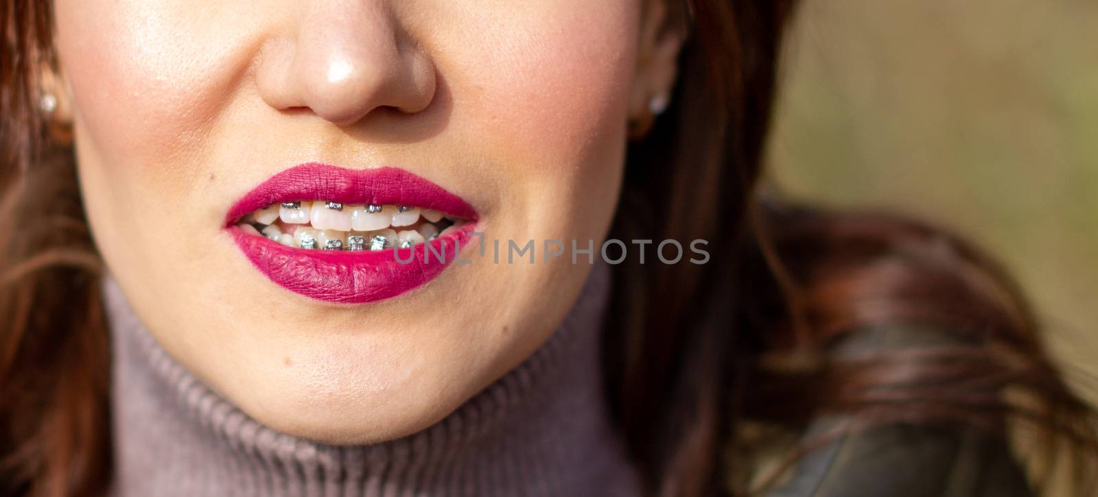 The brace system in the girl's smiling mouth, close-up of red lips by AnatoliiFoto