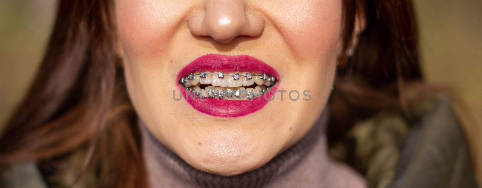 The brace system in the girl's smiling mouth, macro photography of teeth, close-up of red lips. Girl walking on the street