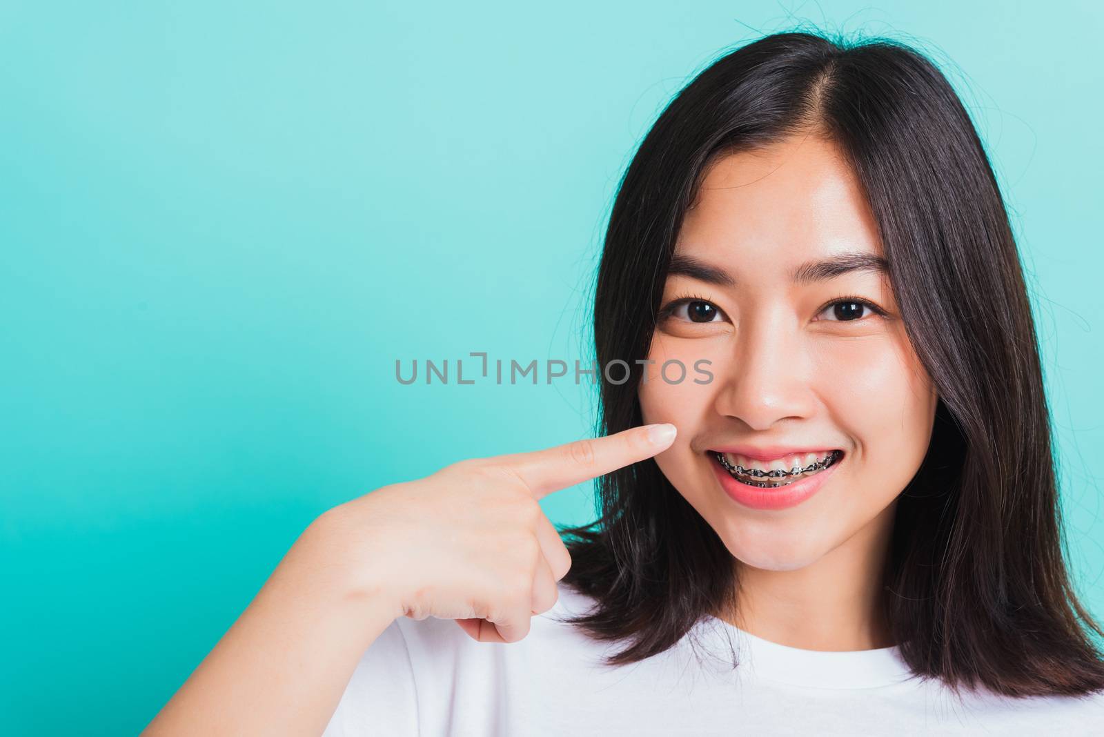 Portrait of Asian teen beautiful young woman smile have dental braces on teeth laughing point finger her mouth, studio shot isolated on a blue background, Medicine and dentistry concept