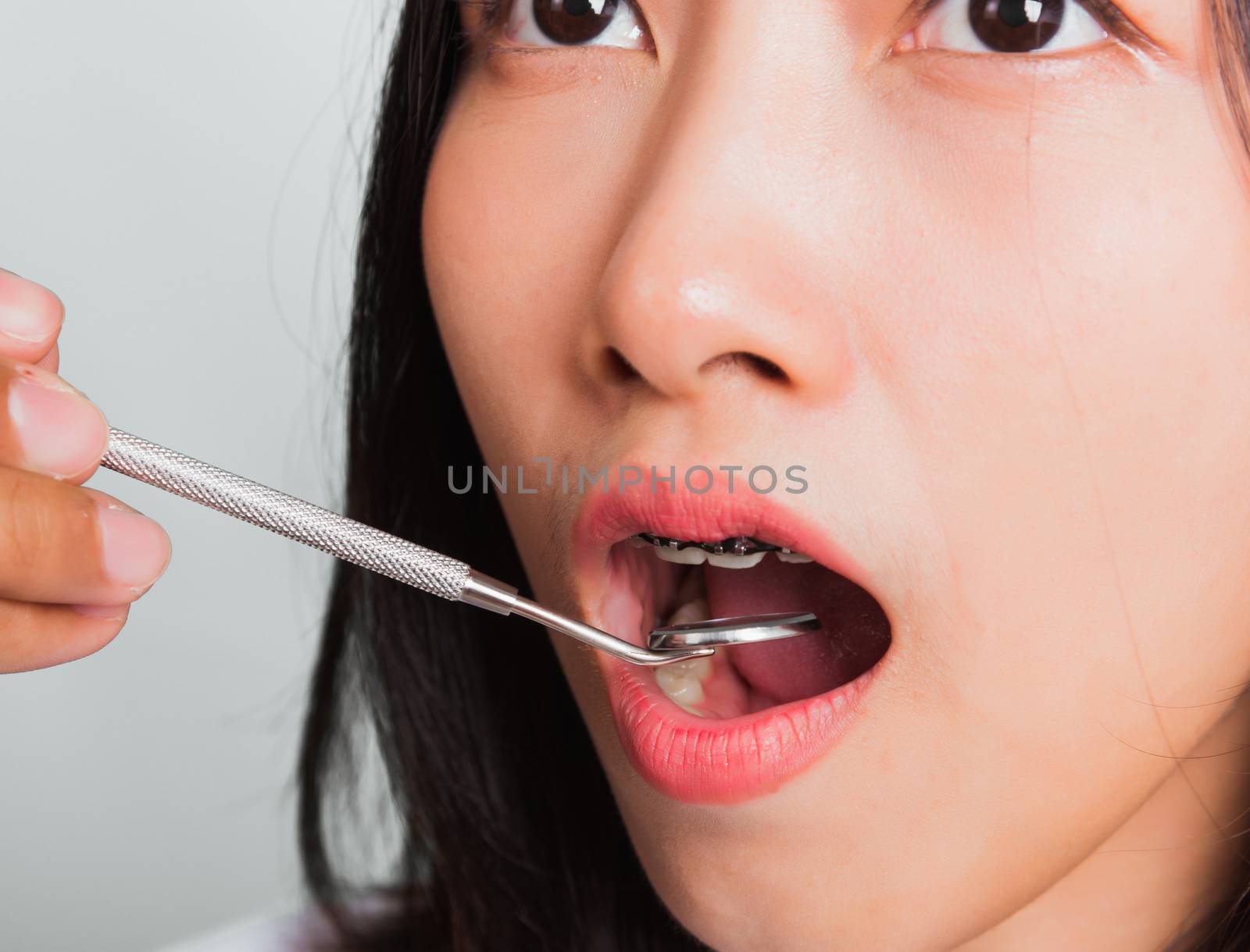 Asian teen beautiful young woman smile have dental braces on teeth laughing and have medical equipment tools for check tooth, isolated on a white background, Medicine and dentistry concept