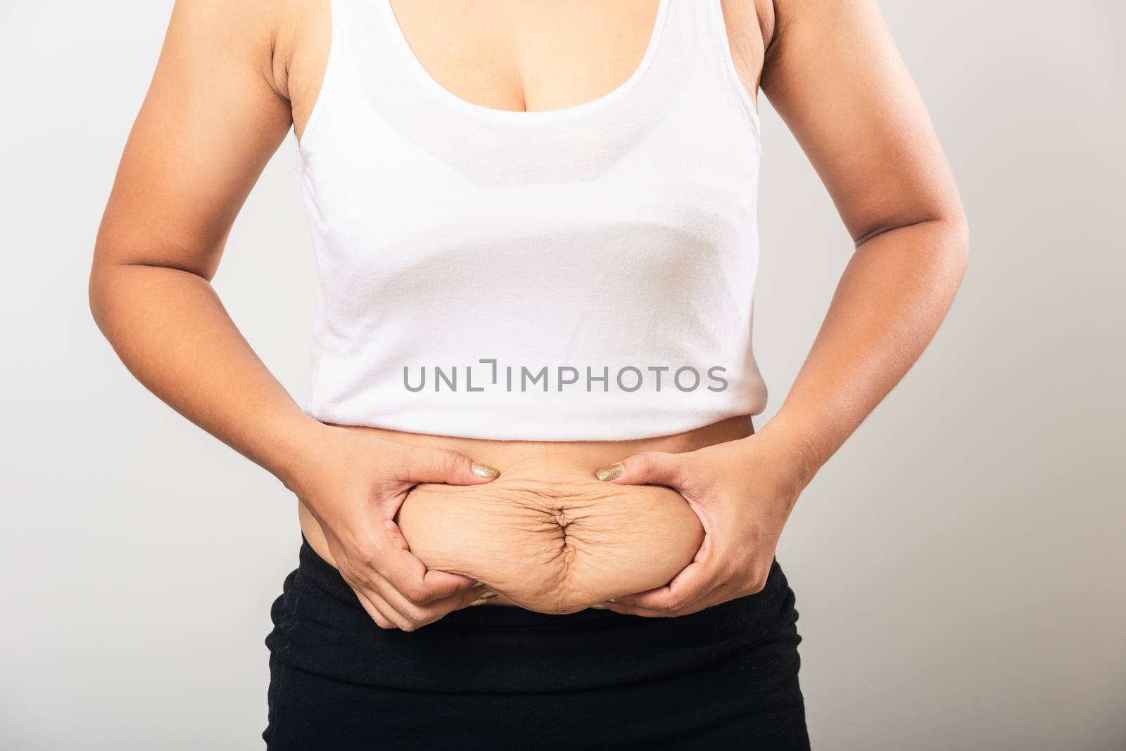 woman showing stretch mark loose lower abdomen skin she fat afte by Sorapop