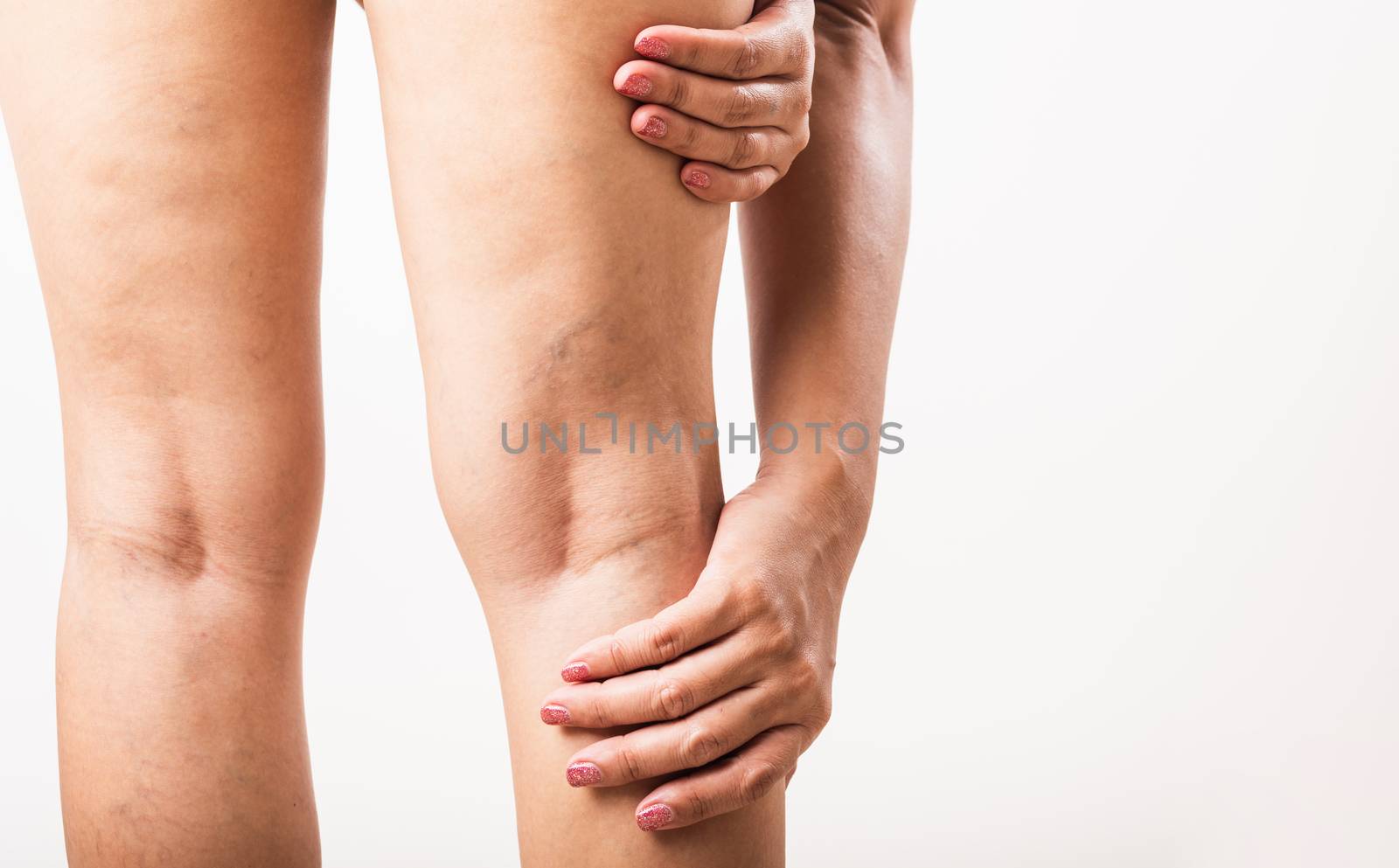 Woman painful varicose and spider veins on leg by Sorapop