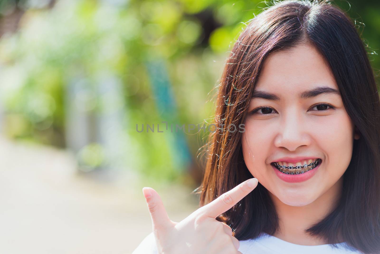 Portrait of Asian teen beautiful young woman smile have dental braces on teeth laughing at outdoor she pointing her teeth, Medicine and dentistry concept