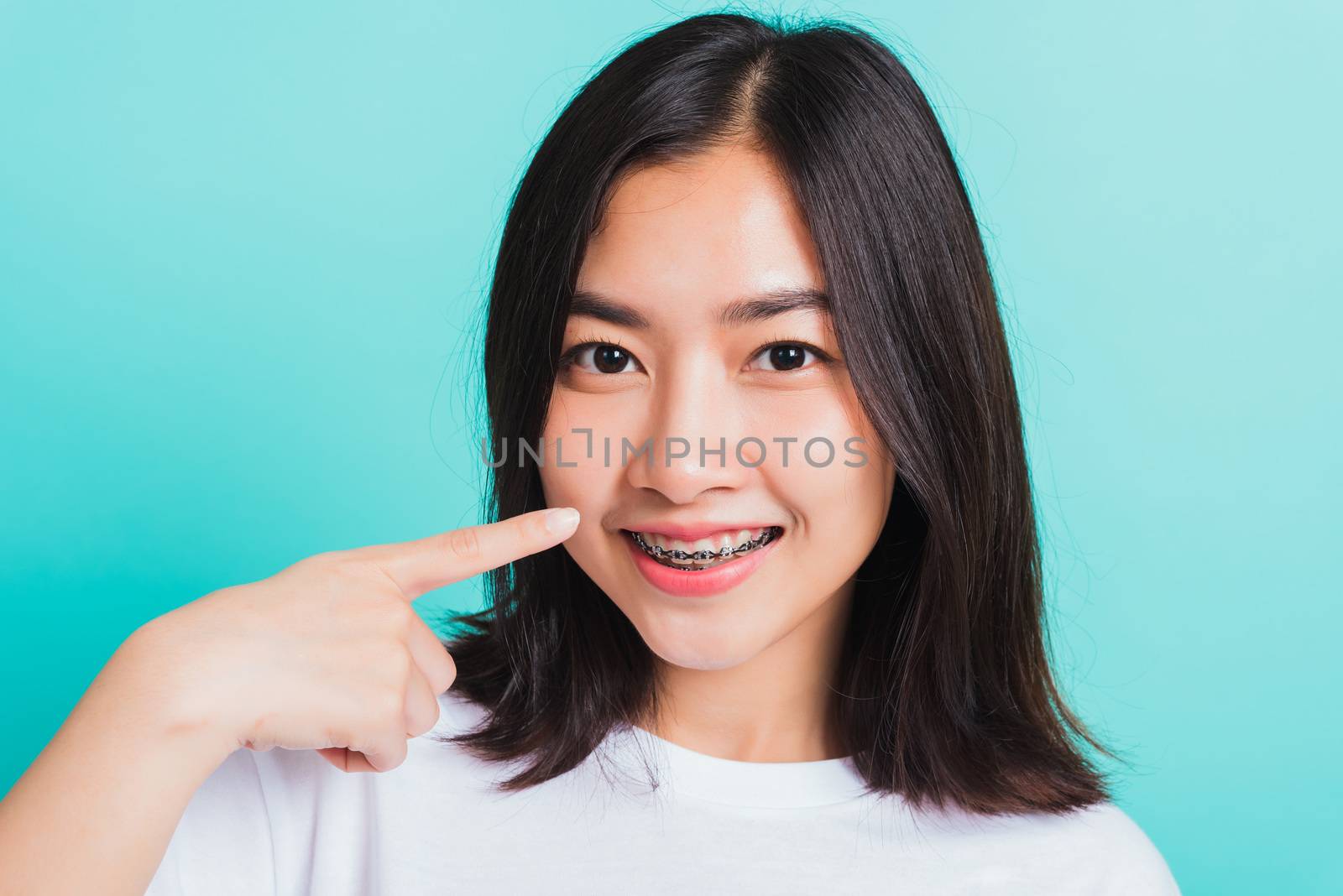 woman smile have dental braces on teeth laughing point finger he by Sorapop