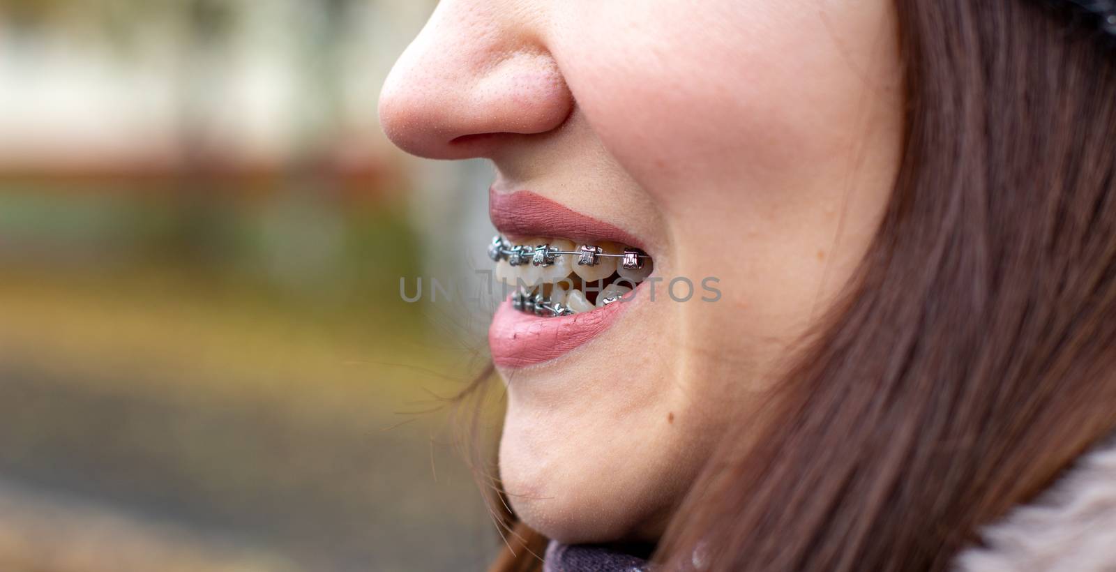 Brasket system in a girl's smiling mouth, macro photography of teeth, close-up of lips