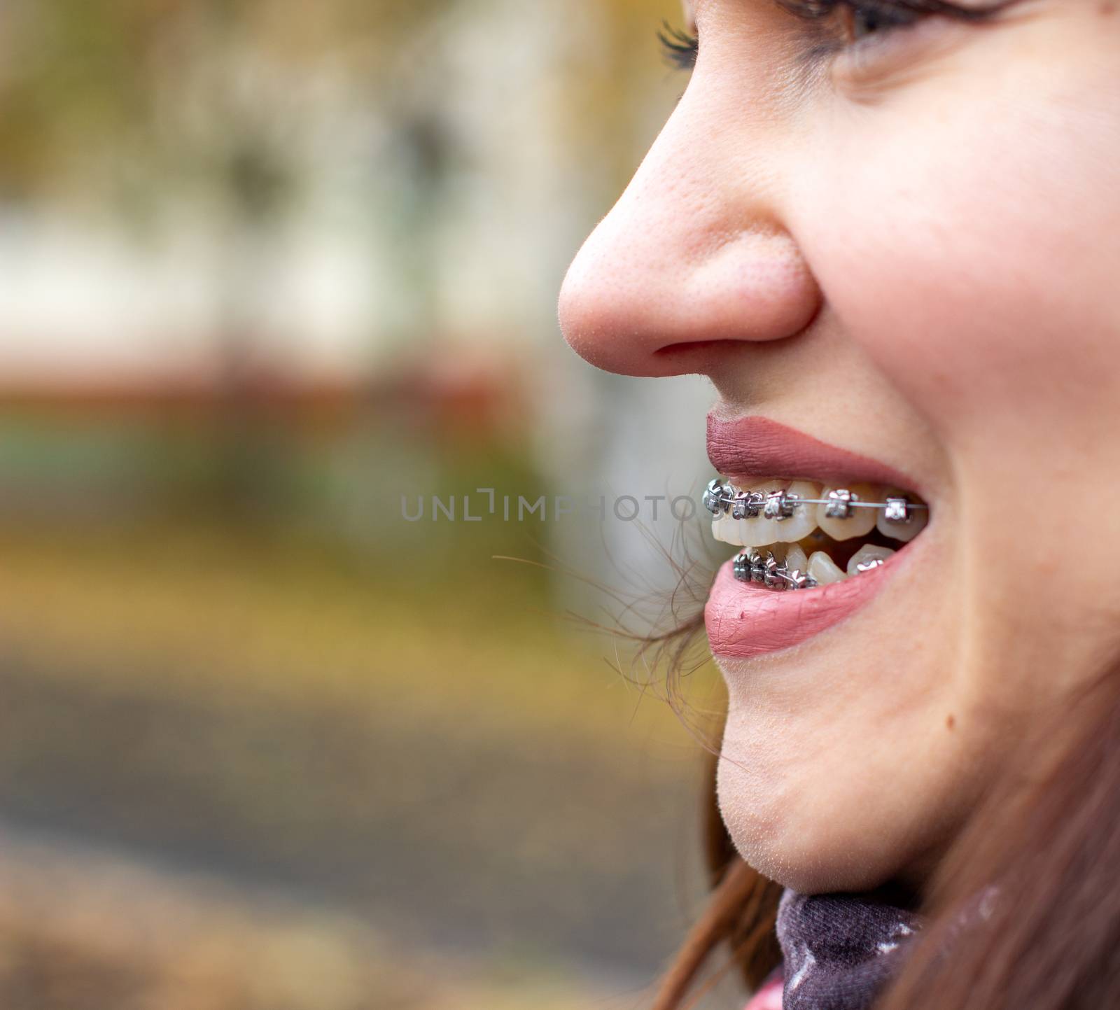 Brasket system in a girl's smiling mouth, macro photography of teeth. large face and painted lips