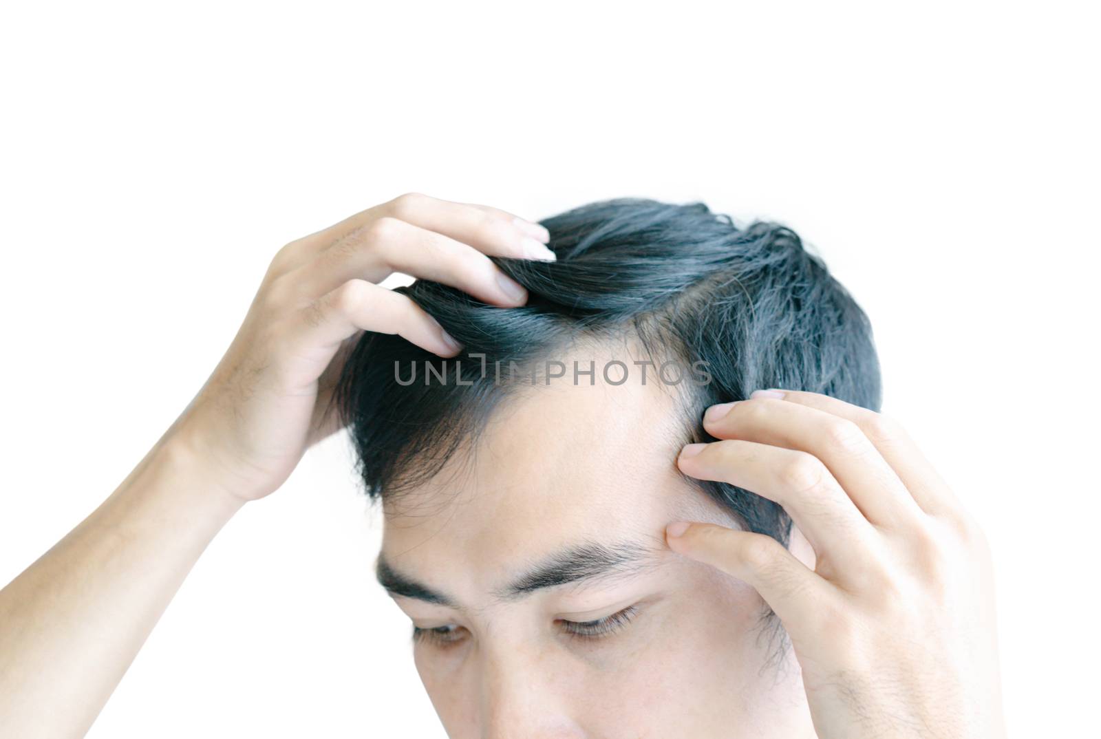 Young man serious hair loss problem for health care medical and shampoo product concept