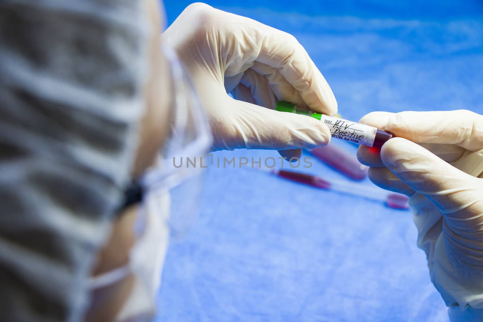 Hiv and aids infection test, doctors face and hand holding tube with blood on the blue background. by Taidundua
