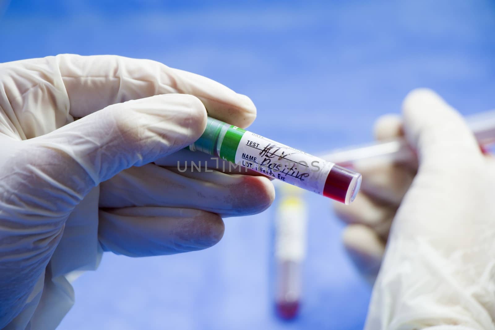 Hiv and aids infection test, hand and tube with blood on the blue background. Studio shoot.