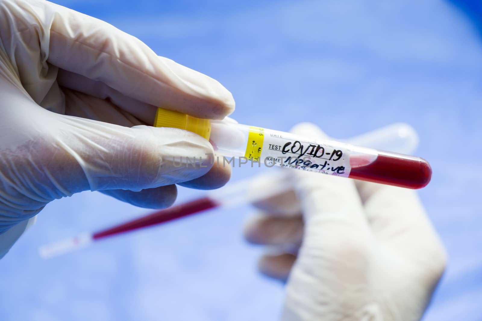 Corona virus negative blood test tubes on the white background, studio shoot. Blood test samples. Diagnosis and laboratory.