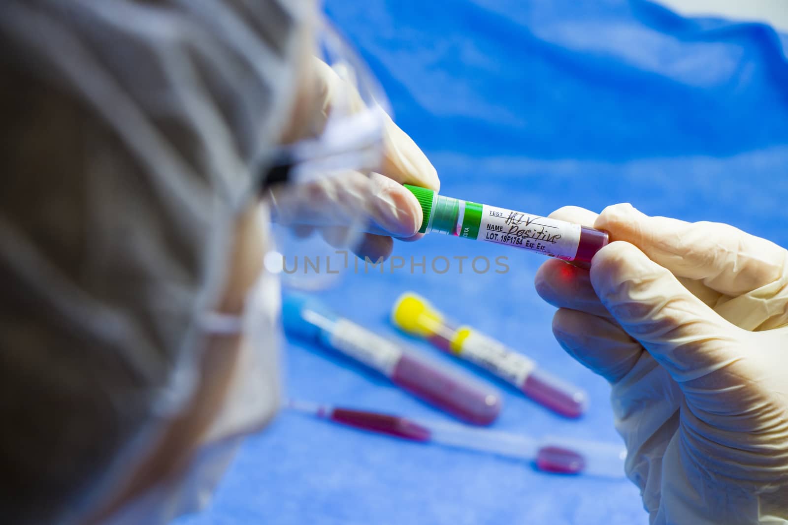 Hiv and aids infection test, doctors face and hand holding tube with blood on the blue background. by Taidundua